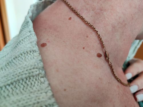 Проверь здоровье: онкодиспансер в Казани запускает акцию #ИсследуйРодинку
