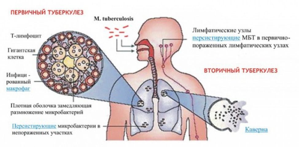 24 марта – Всемирный день борьбы с туберкулёзом