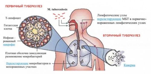 24 марта – Всемирный день борьбы с туберкулёзом