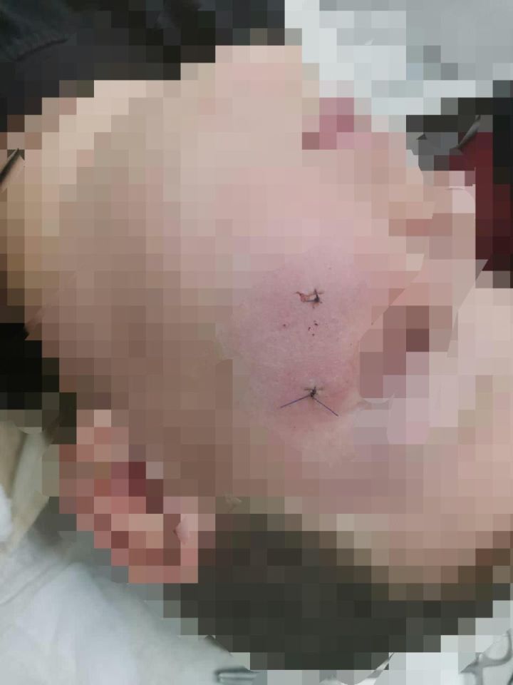 Врачи Спасской ЦРБ прооперировали ребёнка, который зацепил спиннинг за щеку 