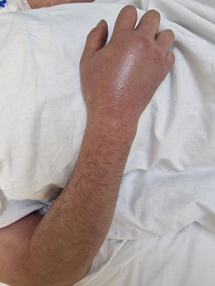 В Татарстане спасли руку мужчины от ампутации после укуса гадюки